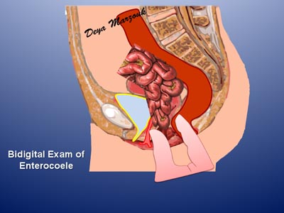 ENTEROCOELE EXAM1